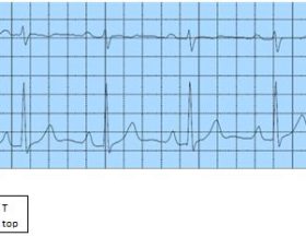 ECG_Normaal