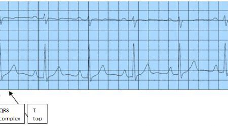 ECG_Normaal